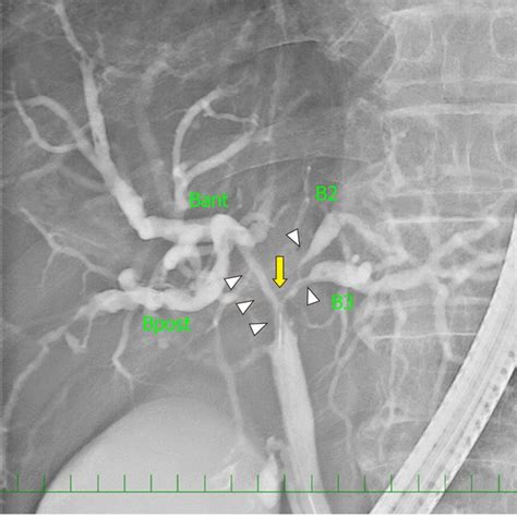 Endoscopic Retrograde Cholangiography Revealed The Severe Stenosis Of