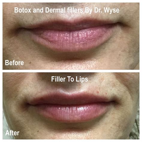 Botox® And Filler Pictures Botox Northbrook Wyse Eyecare