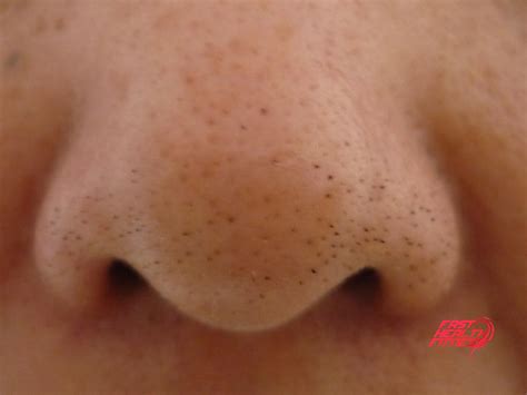 Blackheads can be removed from the nose using a blackhead extractor tool called a comedone extractor. 10 Tips To Get Rid Of Blackheads On Nose - Fast Health Fitness