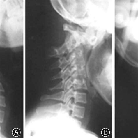 C1c2 Dislocation On X‐ray Before A B And After C Halo Traction