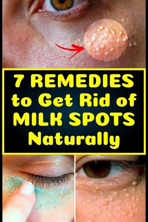 These 7 Remedies Can Remove The Milia Milk Spots From Your Face In