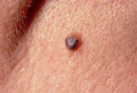 Nonmelanoma Skin Cancers You Need To Know