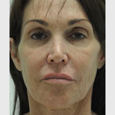 Before And After Vertical Facelift Patient Gallery Beverly Hills Facelift Institute
