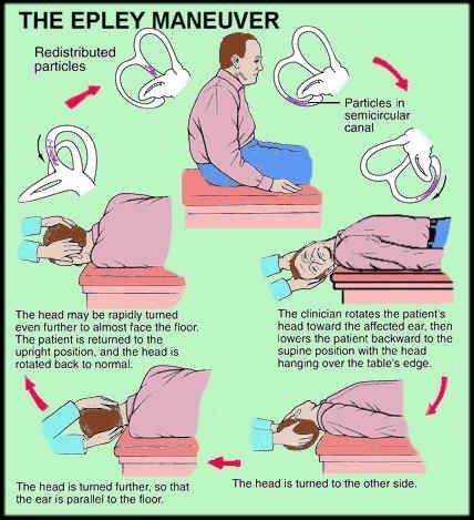 We did not find results for: Epley Maneuver BPPV - Vertigo - PT | Vertigo treatment ...