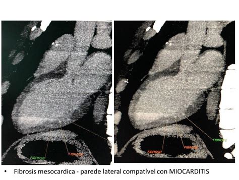 Los pacientes con miocarditis aguda (ma) suelen experimentar una curación espontánea, pero una un porcentaje considerable de ellos evoluciona evaluación por resonancia magnética cardíaca de la persistencia de la inflamación miocárdica después de una miocarditis aguda: Masculino de 20 años con precordialgia y disnea desde hace ...