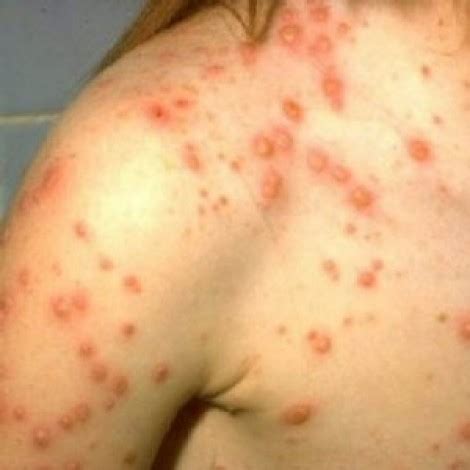 Varicella da adulti: come affrontarla - Tutto per Lei
