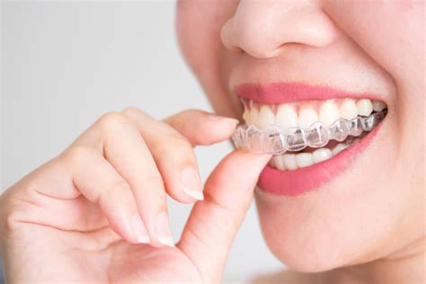 Dentist Uptown Charlotte Invialign Clear Braces