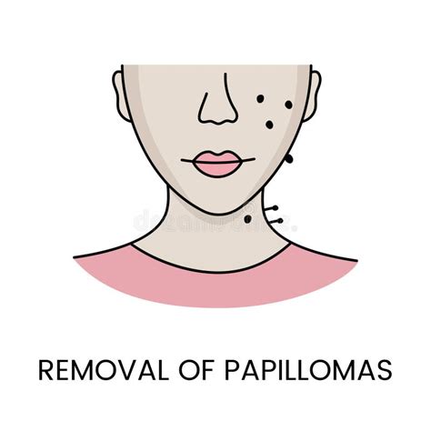 Removal Of Papillomas With The Help Of Laser Cosmetology In Vector