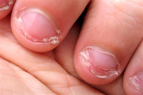 5 Reasons To Stop Biting Your Nails Vital Record