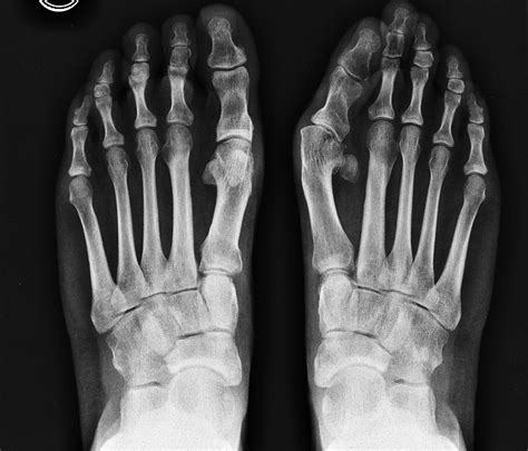 Transfer Metatarsalgia Post Hallux Valgus Surgery Foot And Ankle Clinics