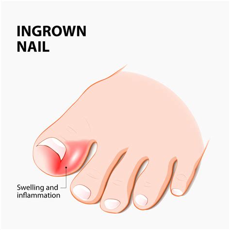 Ingrown Toe Nailwedge Resection Perth Orthopaedic Specialist Centre