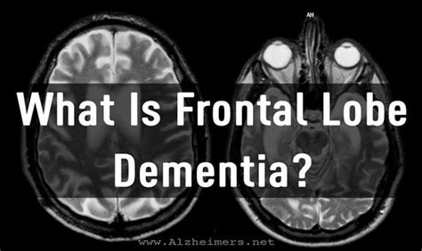 Frontal Lobe Dementia Alzheimers Net Artofit