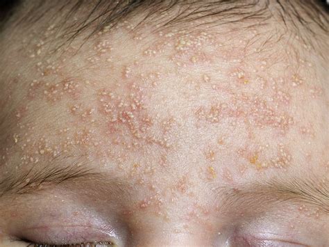 Itchy Rash On Forehead Drbrowns