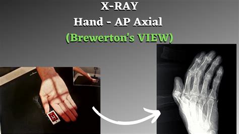 Hand Radiography Positioning Brewertons View Radiology Lectures
