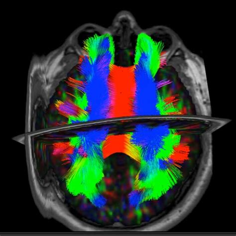 Diffusion Tensor Imaging Dti In Mild Traumatic Brain Injury Mtbi