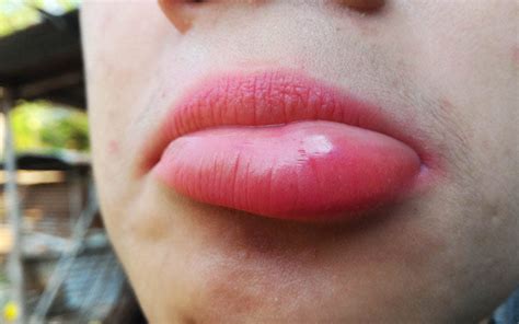 29 How To Treat A Swollen Lip After Dental Work 112023 Ôn Thi Hsg