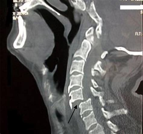 Ct Scan Of Cervical Spine Revealing Partial Anterior Sublaxation C5