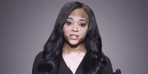 This Woman With Vitiligo Reminds Us Of What Beautiful Really Means