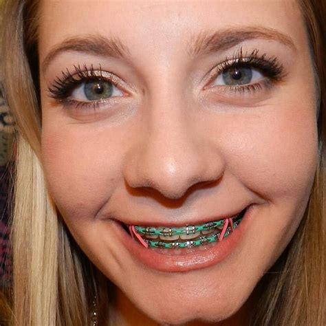 Incredible What Is The Best Color To Use For Braces References Download App