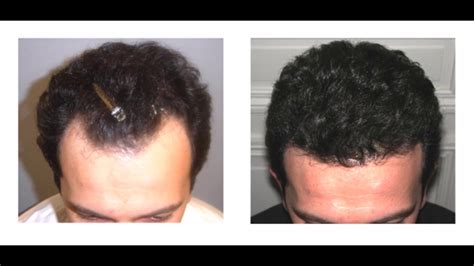 Men who want to sport straight hair tend to iron their hair coconut oil also makes black hair more black. Natural Way To Regrow Lost Hair - How To Use Virgin ...