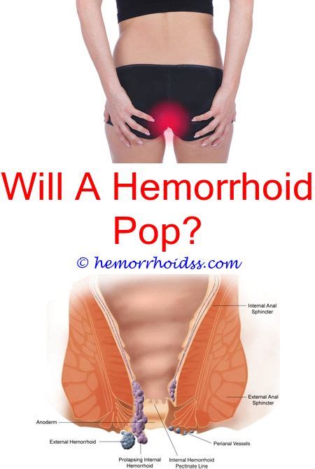 Polas is only used in colombia—and although it has no official meaning in spanish, it does hold some history. What Does Hemorrhoids Mean In Spanish? do hemorrhoids stay ...