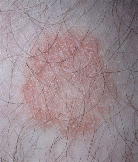 What Are The Healing Stages Of Ringworm Healing Picks
