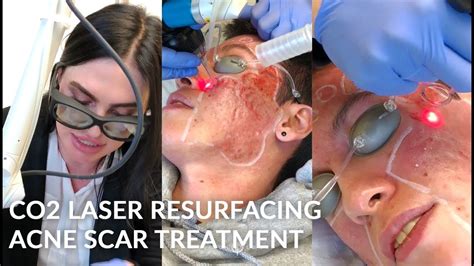 Co2 Laser Resurfacing For Acne Scarring Male With Facial Scarring And