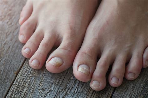 6 Causes Of Yellow Toenails And Treatments That Help The Healthy