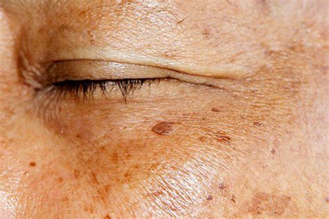 How To Remove Age Spots