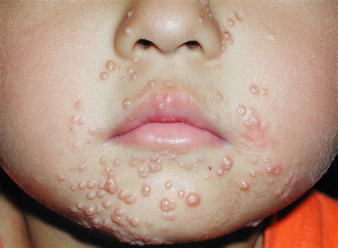 Umbilicated Papules On The Face The Bmj