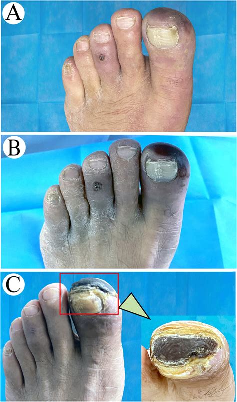 The Evolution Of Blue Toe Syndrome In A Diabetic Patient The American
