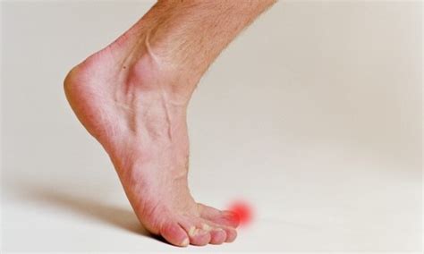 Bruised Heel Symptoms And Treatment