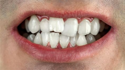 Crooked Teeth Causes Cost Fixation And Treatment Cards Dental