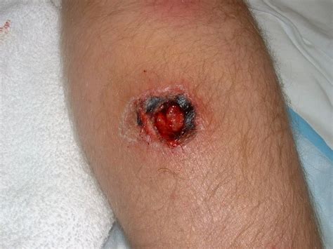 Mrsa Picture Staph Infection Hardin Md Super Site Sample