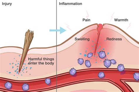 Inflammation The Root Of All Disease Pain Free For Life