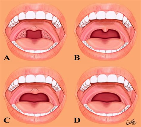 The Uvula Conditions That Dental Hygienists Can Observe During An Exam