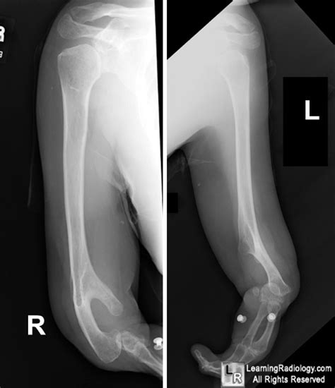 Learningradiology Thalidomide Induced Phocomelia Limb Deformities