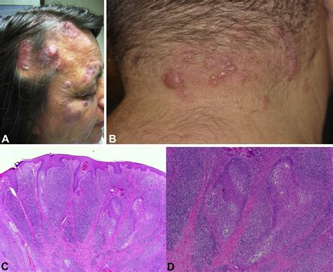 Primary Cutaneous T Cell Lymphoma Mycosis Fungoides And Sézary