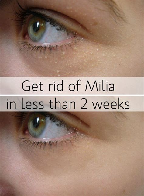 Get Rid Of Milia Fast Bumps Under Eyes Skin Remedies Skin
