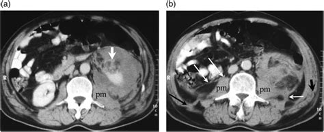 Case 3 Contrast Enhanced Ct Scans At The Lower Kidney Level A And