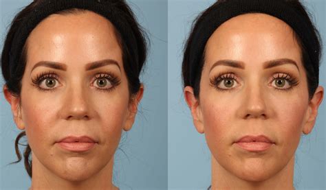 Voluma The Final Piece To The Puzzle Kavali Plastic Surgery And