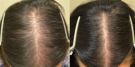 Spironolactone may be able to help you. Finasteride, Spironolactone, and Minoxidil (Females ...