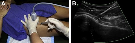 Ultrasound Guided Intra Articular Injection Of The Hip The Nashville