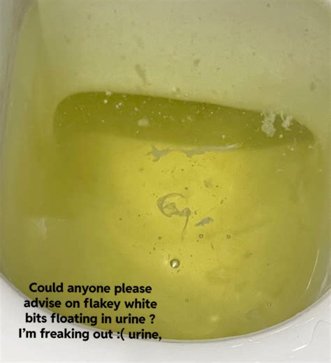 Best R Kidney Images On Pholder White Flaky Floaty Bits In Urine Please Advise