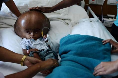 Indian Girl Roona Begum With Rare Swollen Head Condition Dies Suddenly