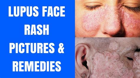 Lupus Face Rash Lupus Face Rash Pictures Lupus Face Rash Chin