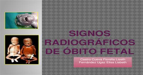 Signos RadiogrÁficos De Óbito Fetal Pptx Powerpoint