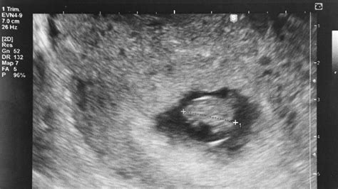 7 Week Ultrasound What You Should See And Why You May Not