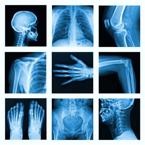 X Rays Really Are Harmful
