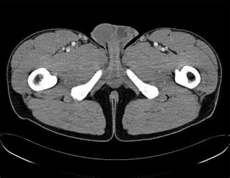 The Ct Image Shows The Presence Of Inguinal Lymph Nodes Open I